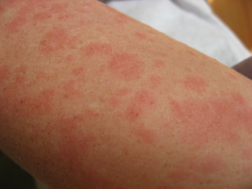 when to worry about hives in child