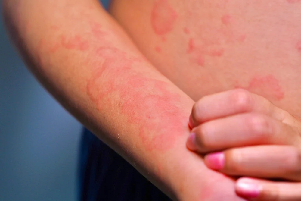 Why Is My Child Breaking Out in Hives?