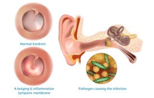 is an ear infection contagious