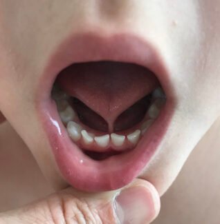 posterior tongue tie