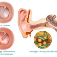 is an ear infection contagious