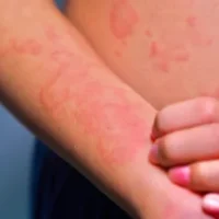 viral hives in children